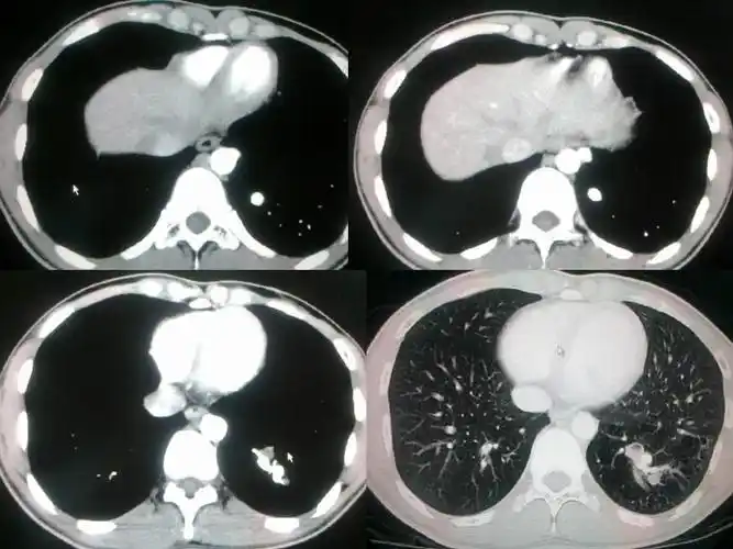 肺隔离症诊断之影像与病理
