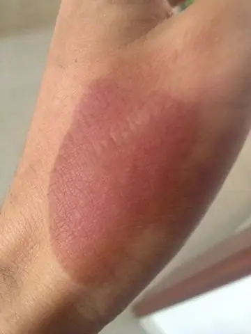 一个礼拜了 烫伤还没好 很严重么 一直不消掉那快红的_百度知道