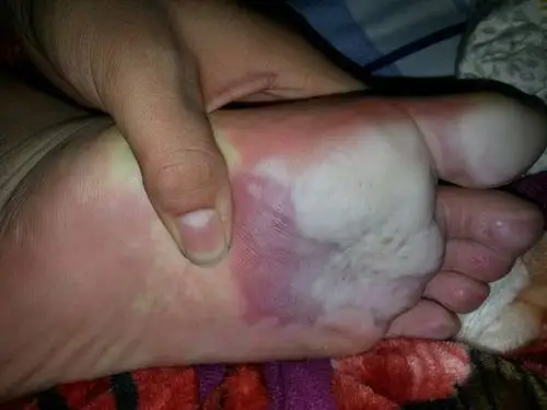 我的脚底板很痛走路很痛.一天下来还很臭