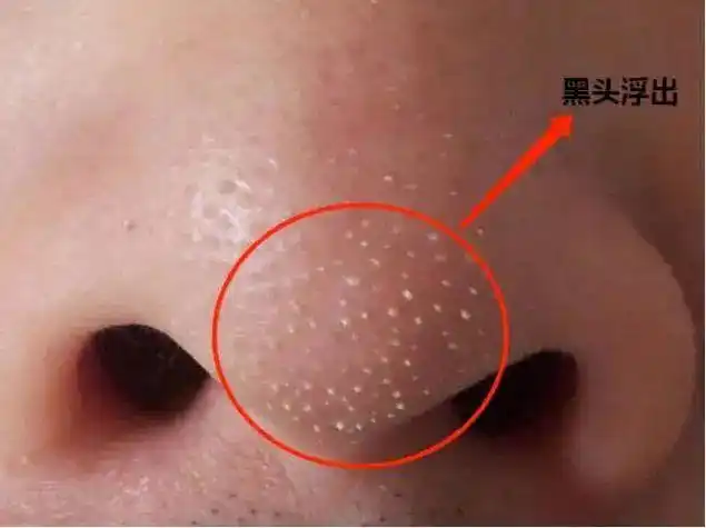 必须要试一下~如果你的黑头粉刺非常顽固,(此信息来源欧优黑头水品牌