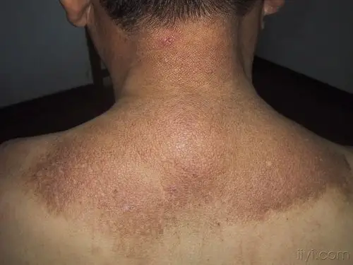 治疗经验? - 皮肤及性传播疾病讨论版 - 爱爱医医学论坛