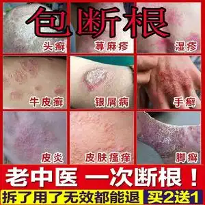 牛皮癣银屑湿疹皮肤病专用治疗止痒去根手足股藓外用癣藓特效药膏