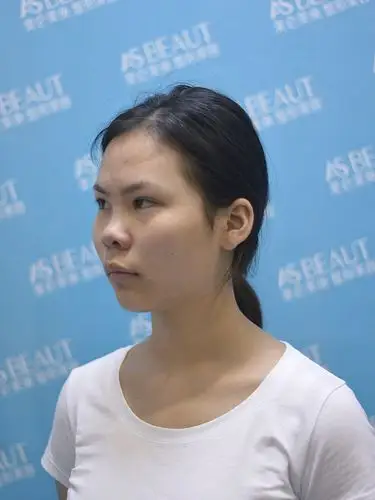 97个人感受:做鼻子之前,我真的就是一张路人脸,基本_圈子-新氧美容