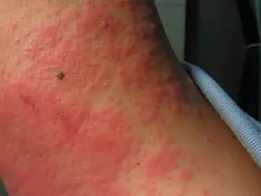 颈部,患上季节性皮炎患者会有红斑,水肿的症状给他们的工作和生活会到