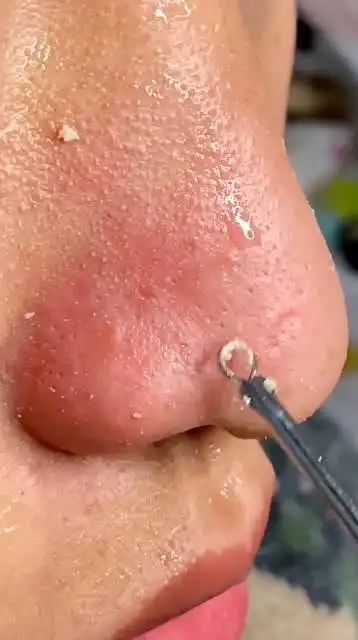 男朋友脸上的毛孔都堵塞了,黑头挤出来的那一刻,真的好有成就感!