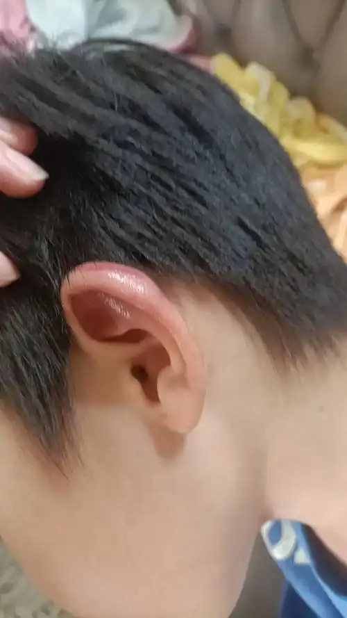 第一次摔下床底,直接成猪耳朵,又肿又红又紫.心疼死我的宝贝了 - 抖音