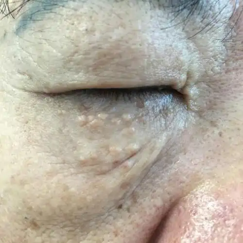 脚部扁平疣症状图片