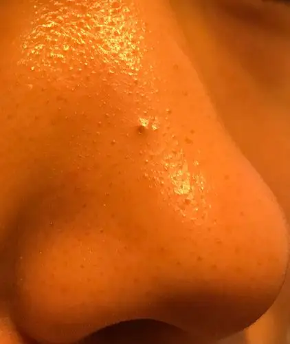 鼻子上出了一个超大毛孔,像火山,中间一个大坑,是什么情况,要用什么药