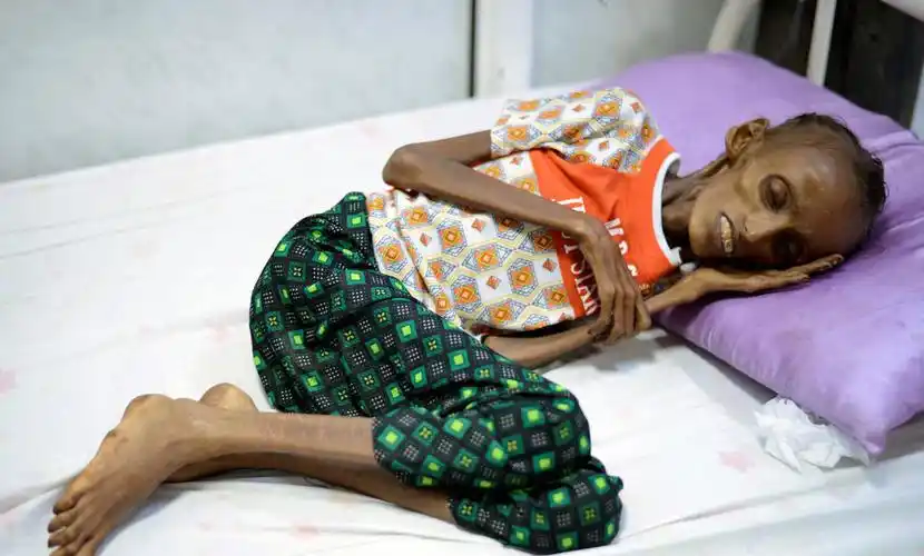 也门营养不良"瘦如干尸"少女被救治后恢复容颜