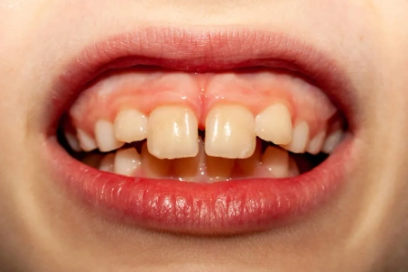 儿童严重大龅暴牙图片