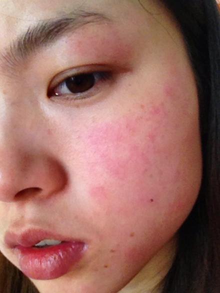 【皮肤过敏】孕妇皮肤过敏症状_皮肤过敏怎么办 - 妈妈帮微专题