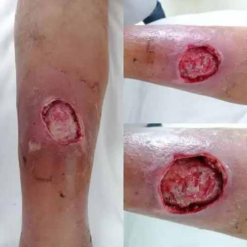 周围感染失活皮肤慢慢变黑坏死 感染范围慢慢局限 创面逐渐干净 皮下