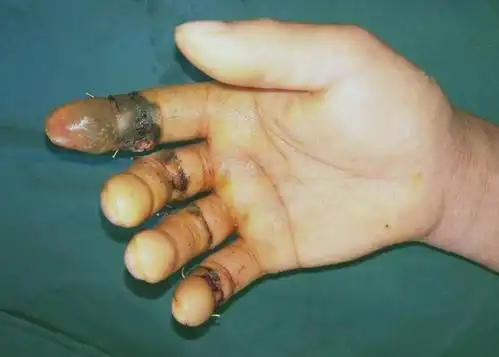 四指齐断43岁的他到底经历了什么