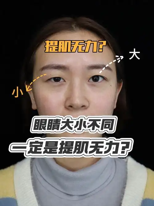 两只眼睛大小不同,一定是肌无力吗?