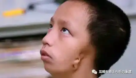 当小耳孩子处于这种症状时,不仅需要耳廓整形,听力修复,还得做面部