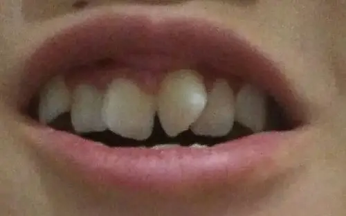 我的牙齿超级爆,怎么办?听别人说牙齿矫正后会提前脱落,还会对牙齿