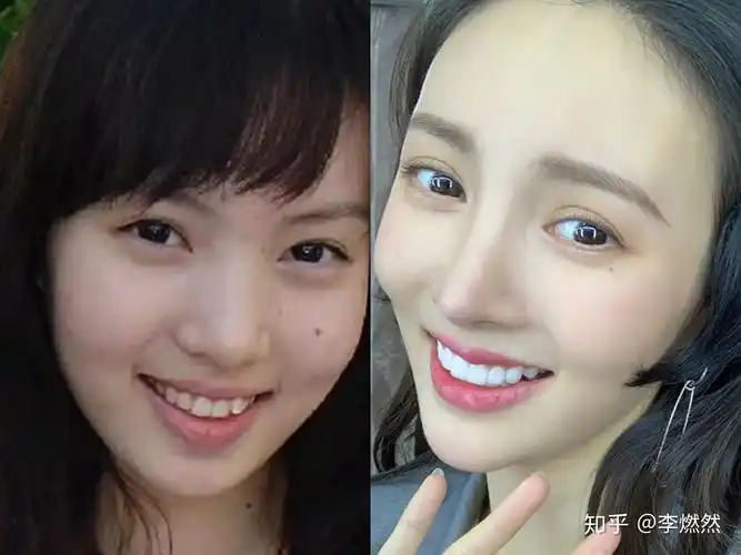 金晨嘴歪是整容后遗症普通人嘴歪应该怎么解决