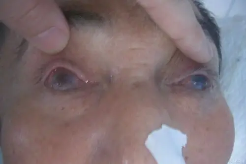 【讨论】暴露性角膜溃疡并穿孔 - 眼科专业讨论版 -丁香园论坛