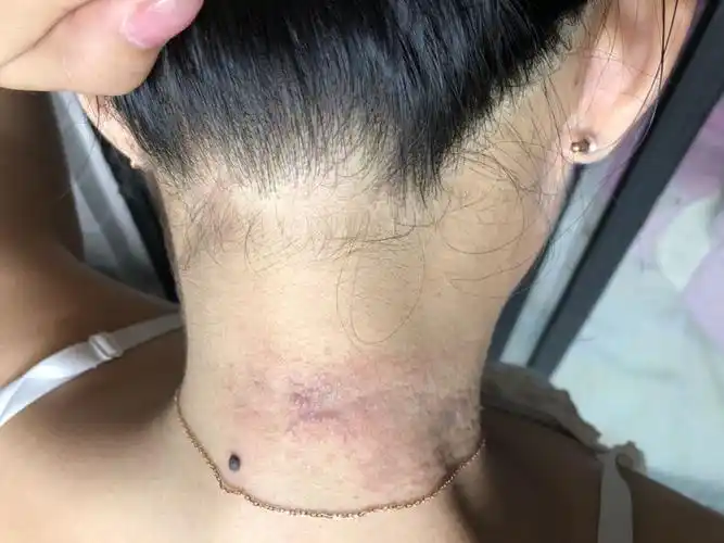 请医生看一下我脖子后长的一圈水泡是什么,有点痒痛,很久不见好.