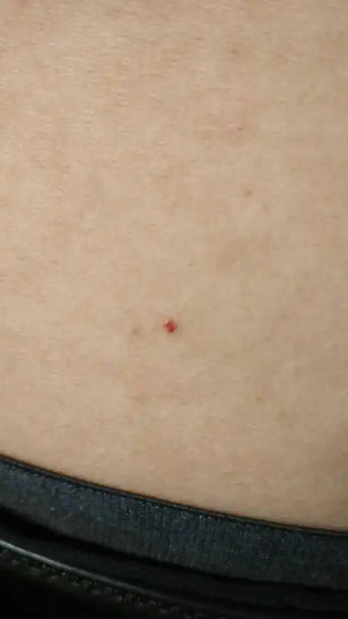 高分悬赏:帮我看下我身上的这些小红点是怎么回事?见图