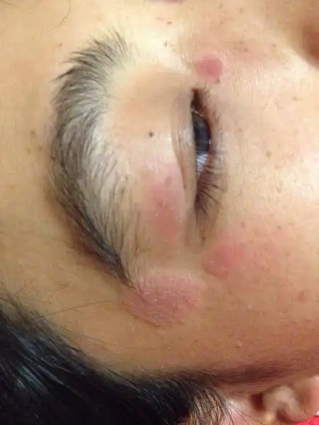 问:如图,怀孕五个月了,眼睛周围起的东西,起皮,而且有时痒