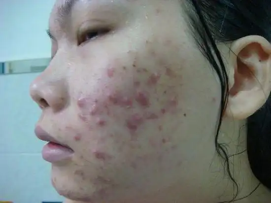 身体6个表现,说明体内毒素超标,需要排毒