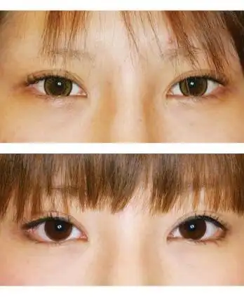 下睑下至术的介绍