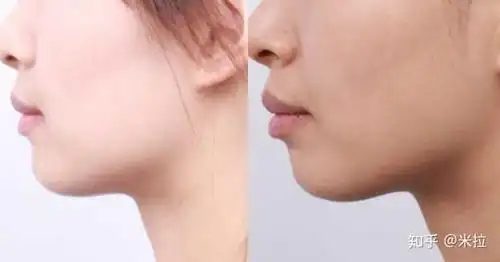 戴过牙套(矫正牙齿)的人脸型变了吗?