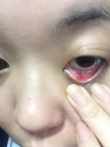 眼睛眼皮里红肿了一个圆点,不疼也不痒,但是就好多天一直那一块都是红