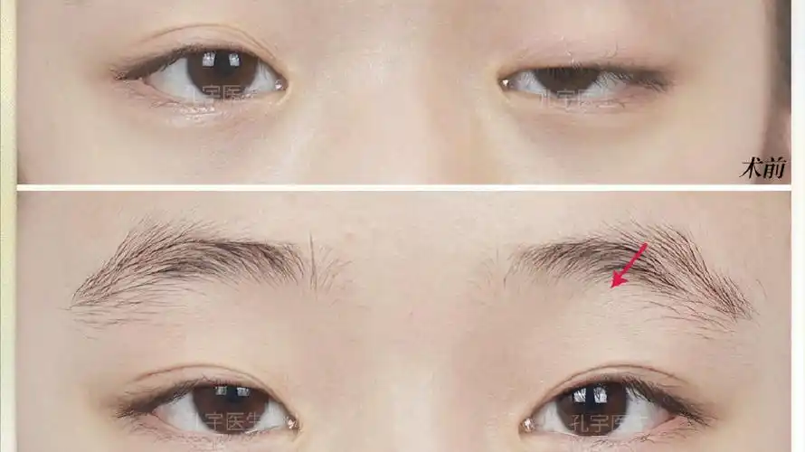 重症肌无力上睑下垂如何治疗?检查,诊断,制定方案,术后护理