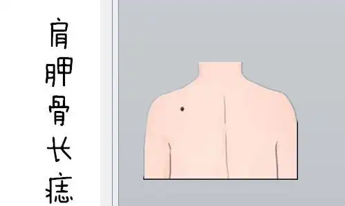 肩胛骨长痣一个人的肩胛骨的位置处长有吉痣,在相学当中,被称之为"