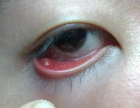 右眼睛右下角下眼皮内部长了个绿豆大小的疙瘩