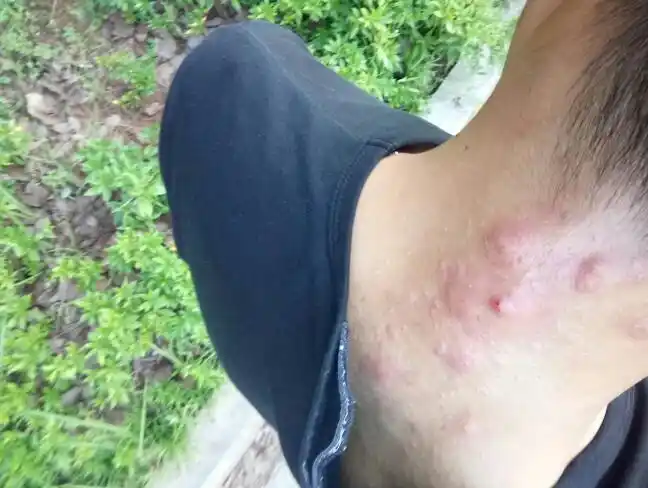 最近喝了点红酒突然严重了,我自己看着都害怕,医生说是毛囊炎