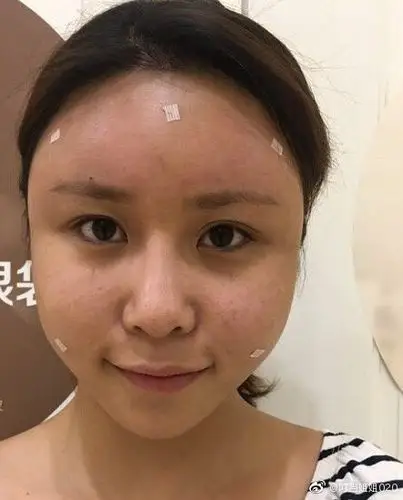 日记本自体脂肪面部填充案例对比图