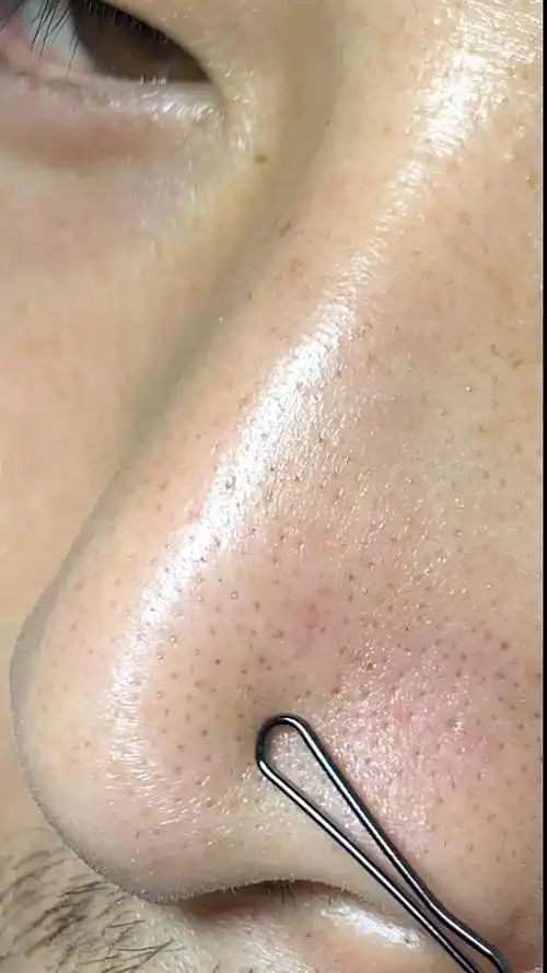 黑头白头粉刺一招解决