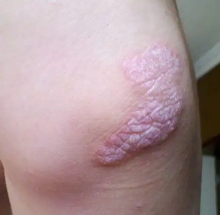 我胳膊肘上上了东西,不疼不痒,一道夏天就有,冬天就自然消失.