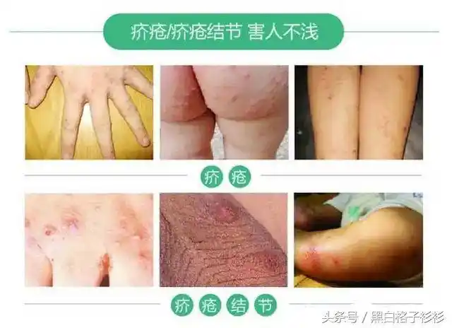 如何判断疥疮已经完全好了疥疮有什么危害