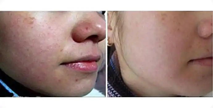 激光祛红血丝前后对比图 激光祛红血丝效果图 激光祛红血丝前后对比