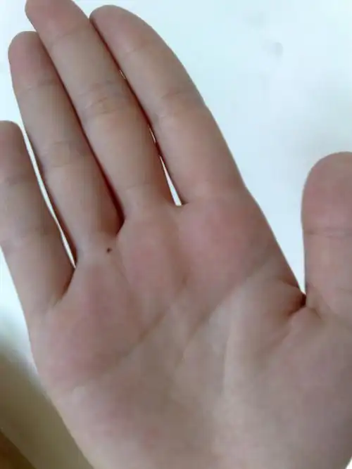 女生右掌心的无名指底部有颗痣 会怎么样吗