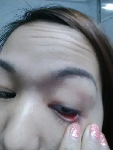 第一次右眼下眼皮边缘长了一颗小痘丁是什么情况?