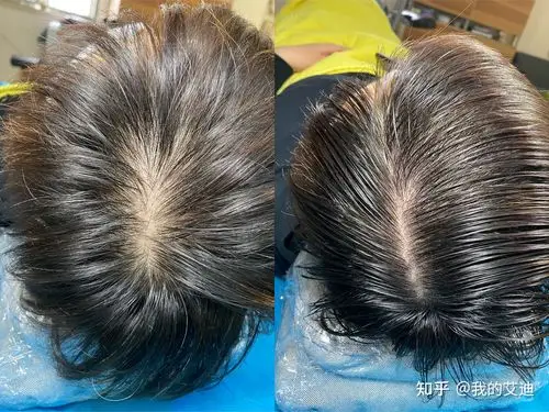 女生脱发产后脱发也可以纹发