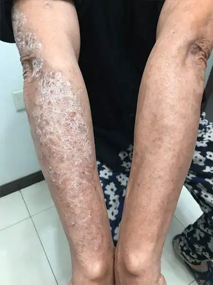 胳膊肘长癣图片