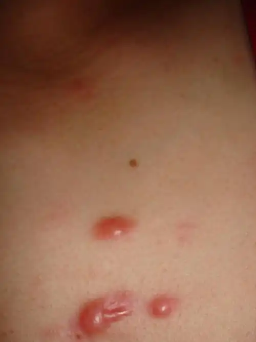 我给rmb1000做回回报,谁能帮我胸部的几个痘痘医好