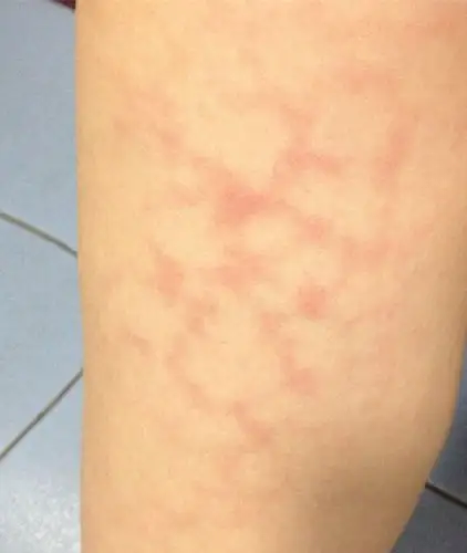 昨天发现小腿上局部位置出现这样的情况见图