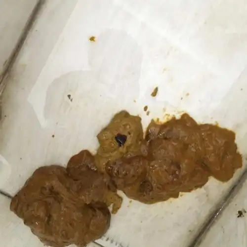 大便照片高清,痔疮大便出血大便照片-图片大观-奇异网