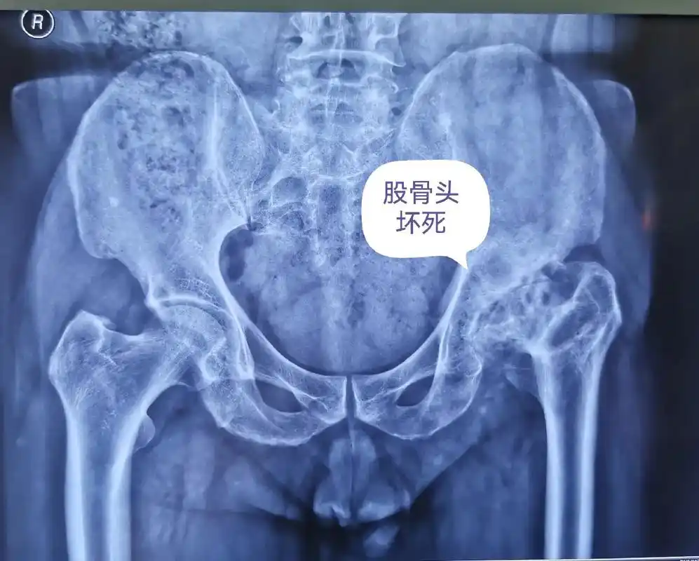 看图说话.股骨头坏死图片 - 抖音