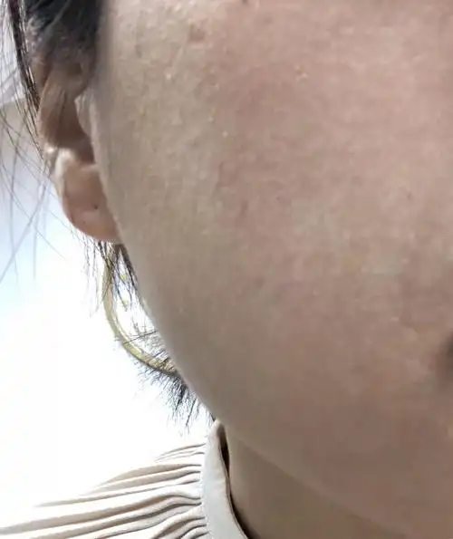 每次去外地玩脸部皮肤都会变的很粗糙是什么原因?