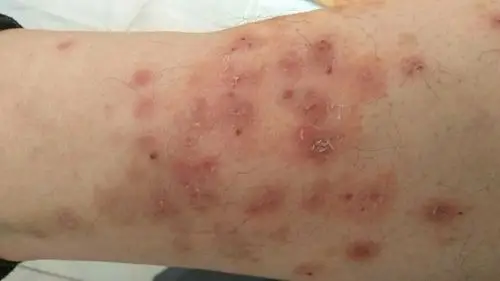 请问这是什么皮肤病?