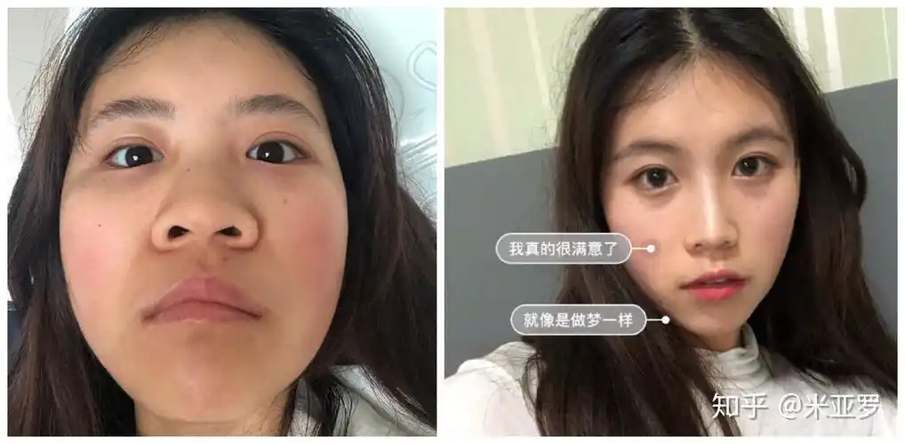 塌鼻子是大众脸,朝天鼻会拉低颜值,几种"丑鼻型"你中了吗?