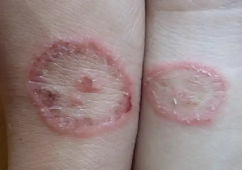 得了体癣平时该怎么做